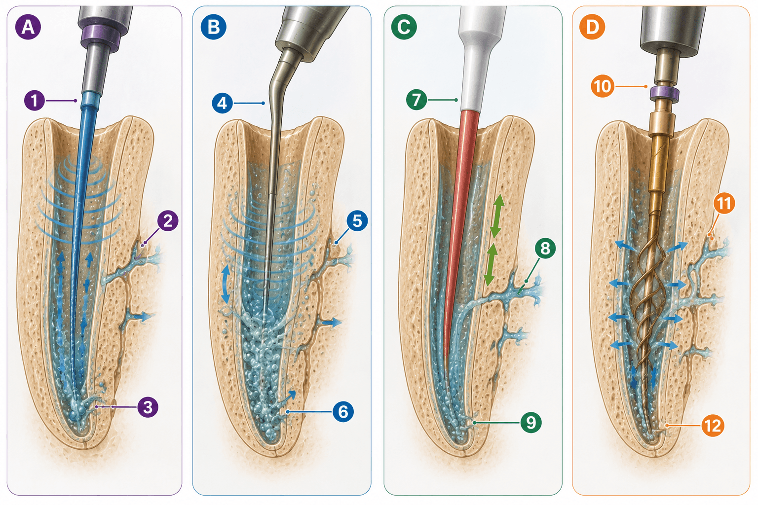 Figura 2 asociada a activación del irrigante y propiedades mecánicas de la dentina radicular