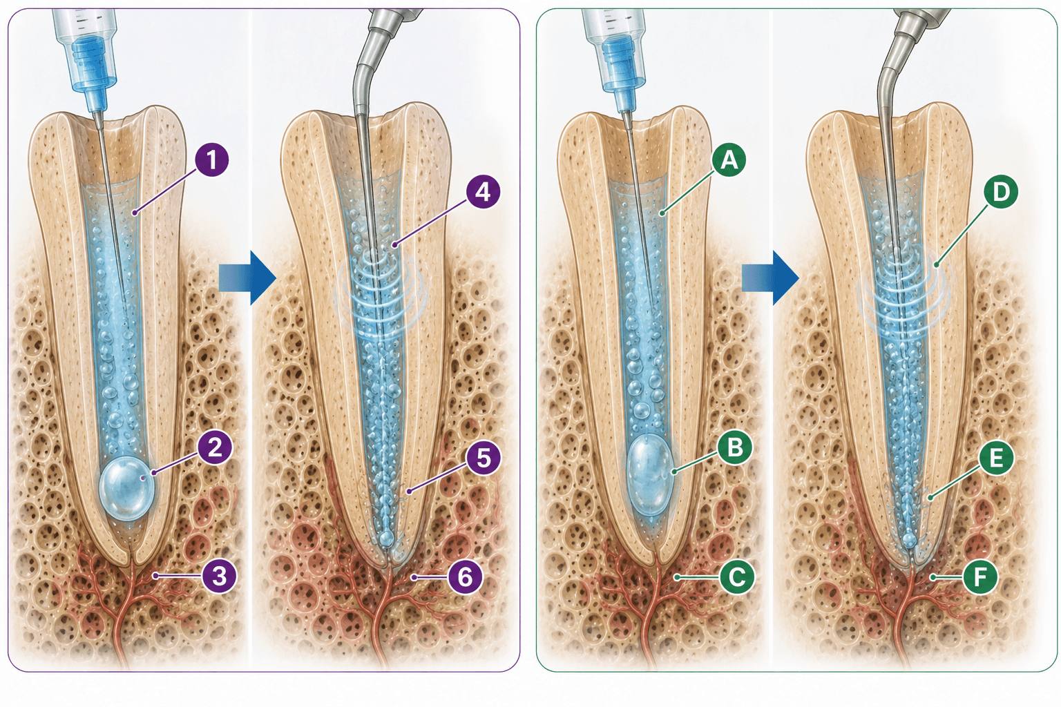 Figura 3 asociada a activación del irrigante y propiedades mecánicas de la dentina radicular