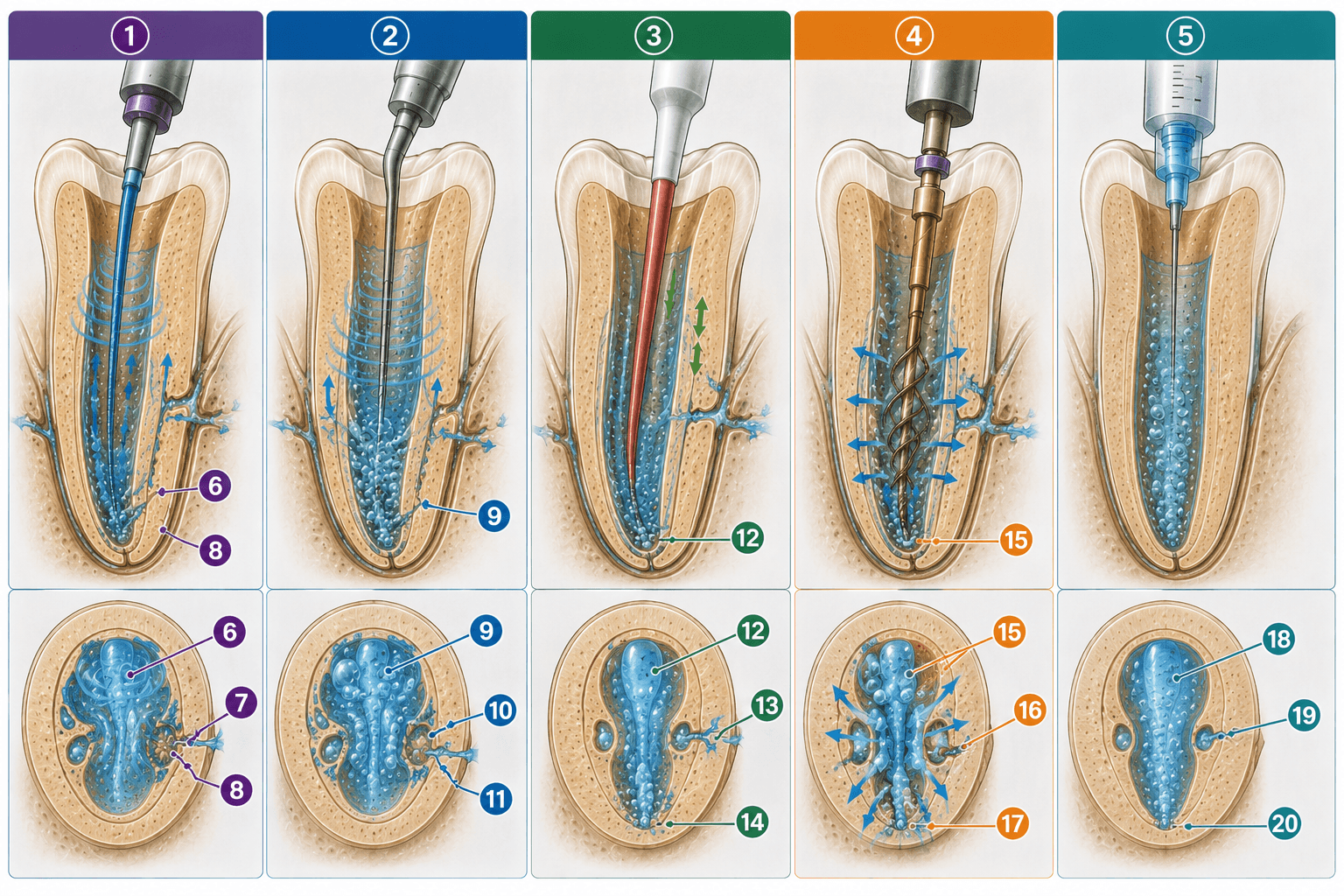 Figura 6 asociada a activación del irrigante y propiedades mecánicas de la dentina radicular