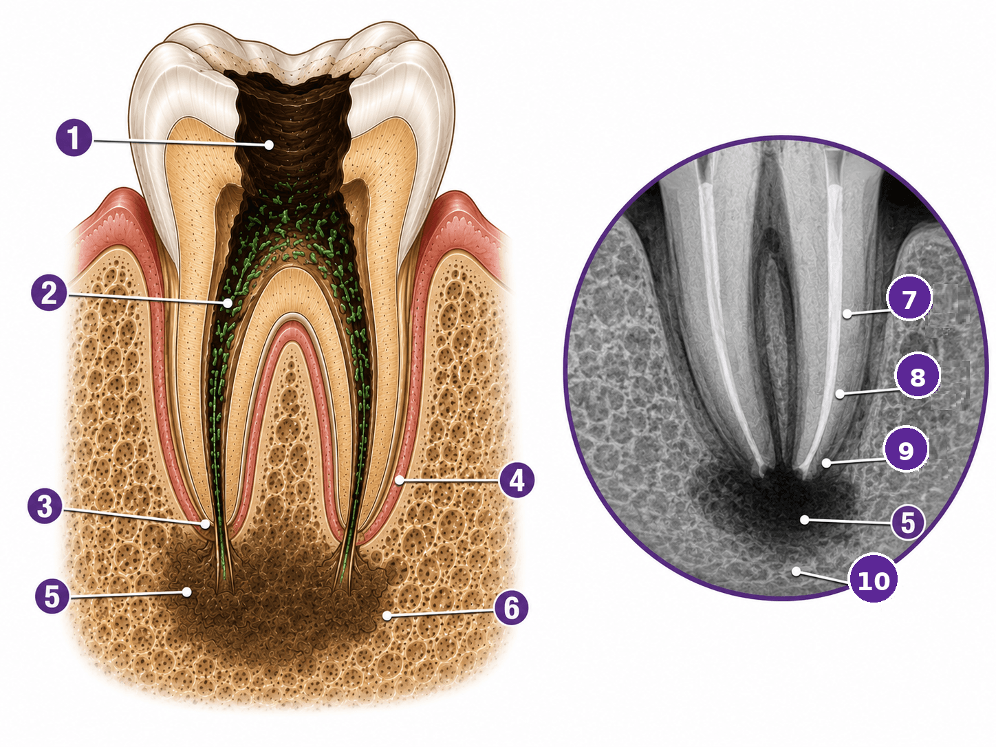 Figura 2 asociada a endodoncia regenerativa con i-prf en dientes maduros necróticos