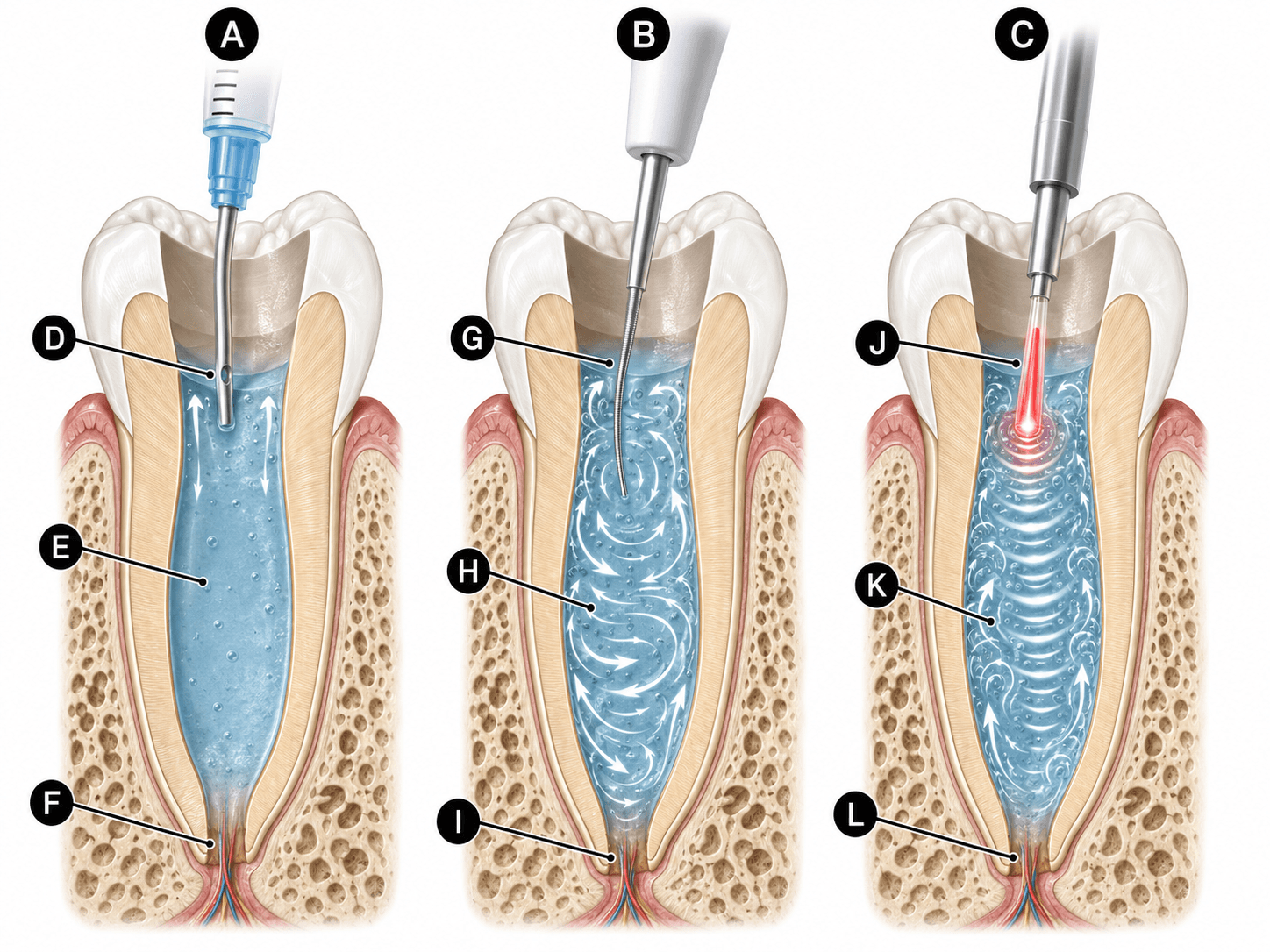 Figura 3 asociada a láseres en endodoncia