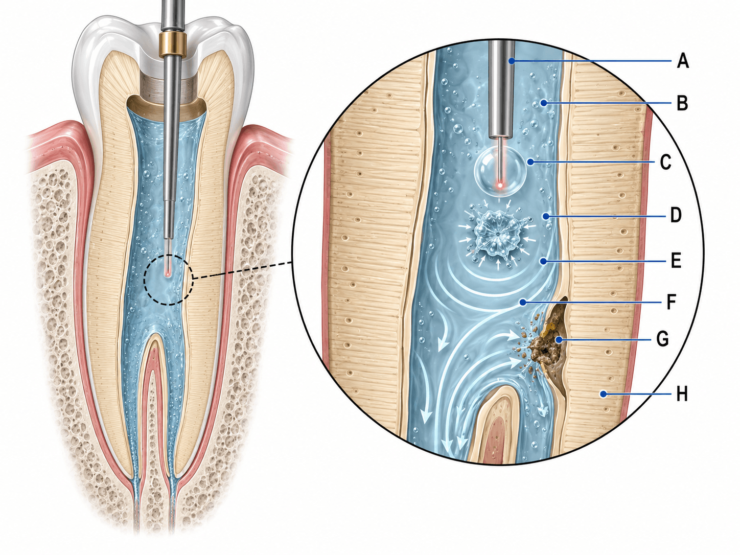 Figura 4 asociada a láseres en endodoncia