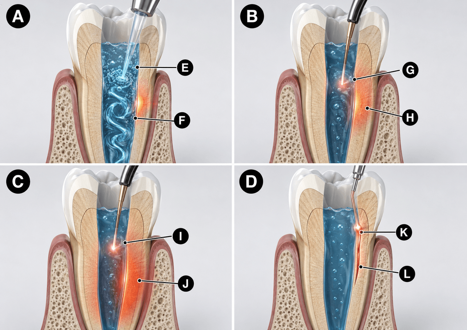 Figura 5 asociada a láseres en endodoncia