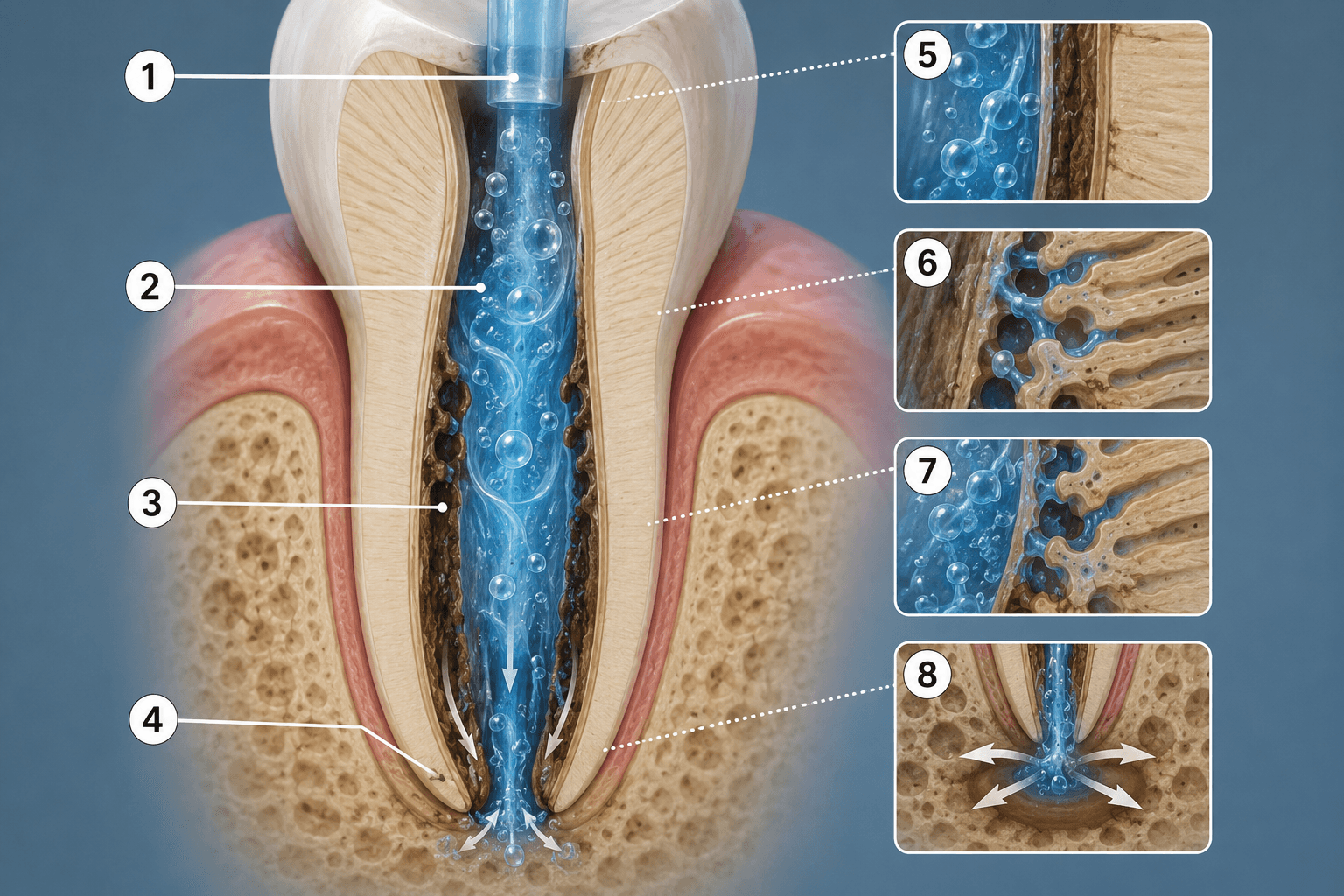 Figura 6 asociada a láseres en endodoncia