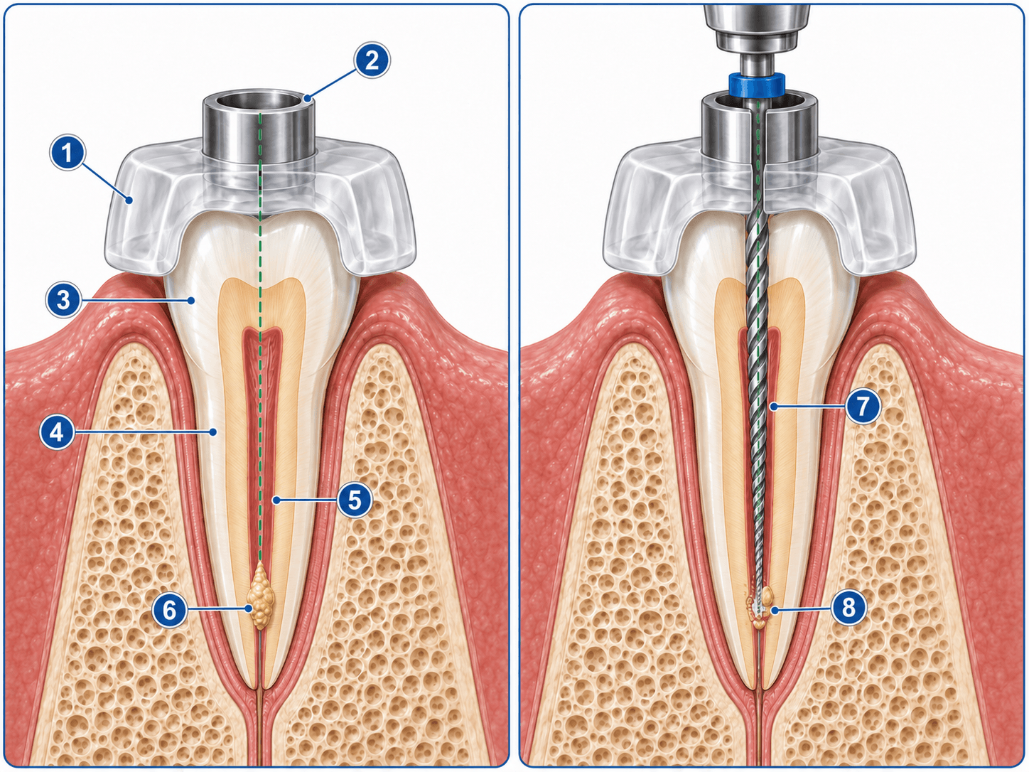Figura 4 asociada a mangas guía en endodoncia