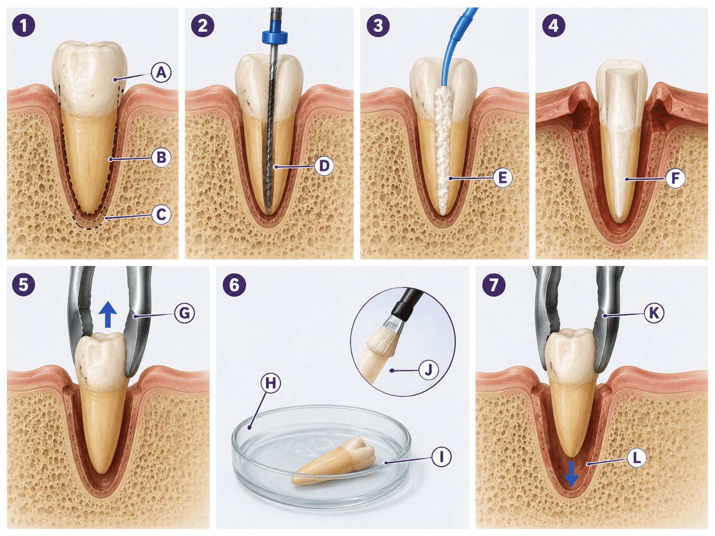 Figura 5 asociada a reimplante dental intencional