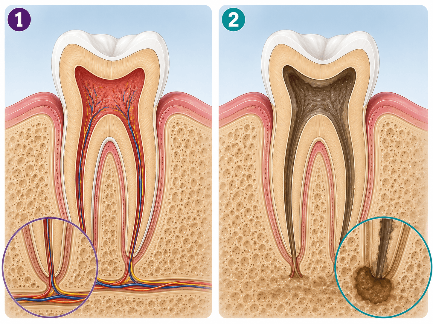 Figura 2 asociada a endodoncia regenerativa en un incisivo inmaduro traumatizado