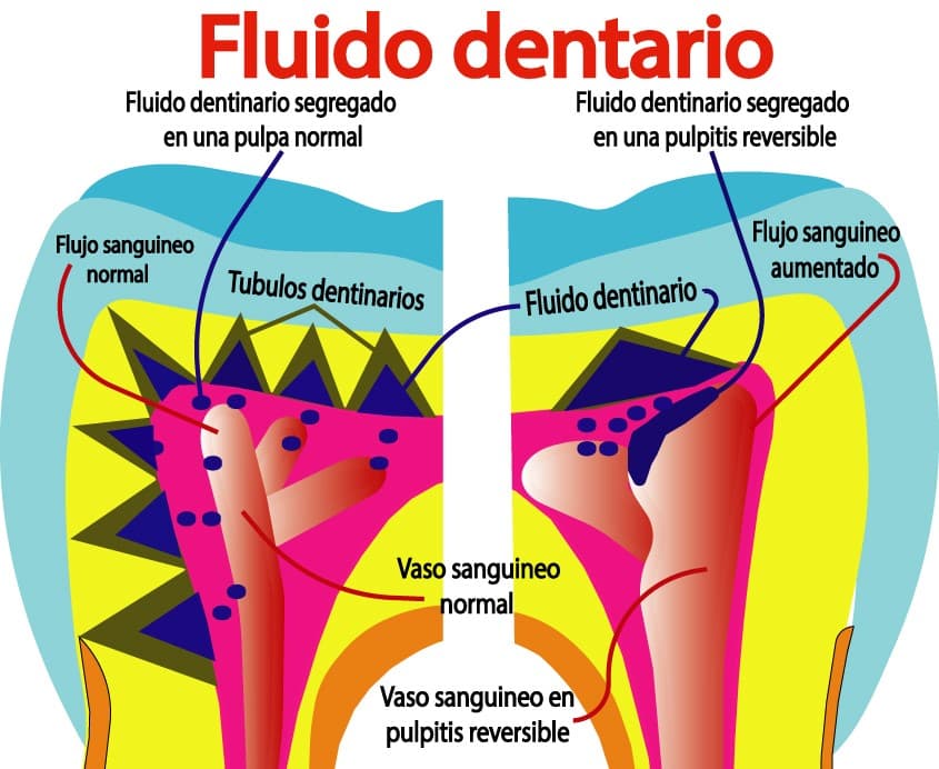 Fluido dentinario