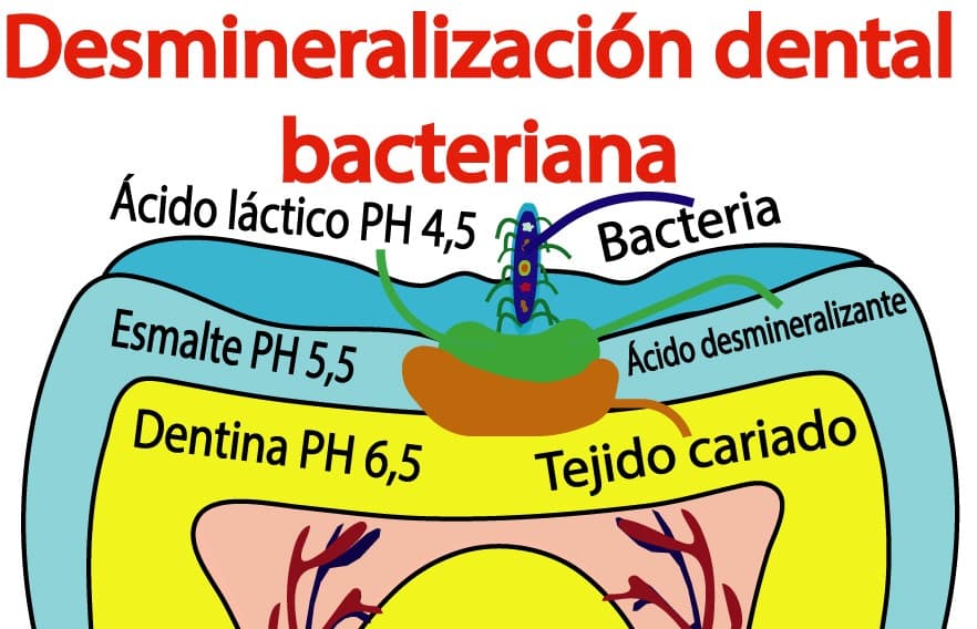 Desmineralización dental bacteriana