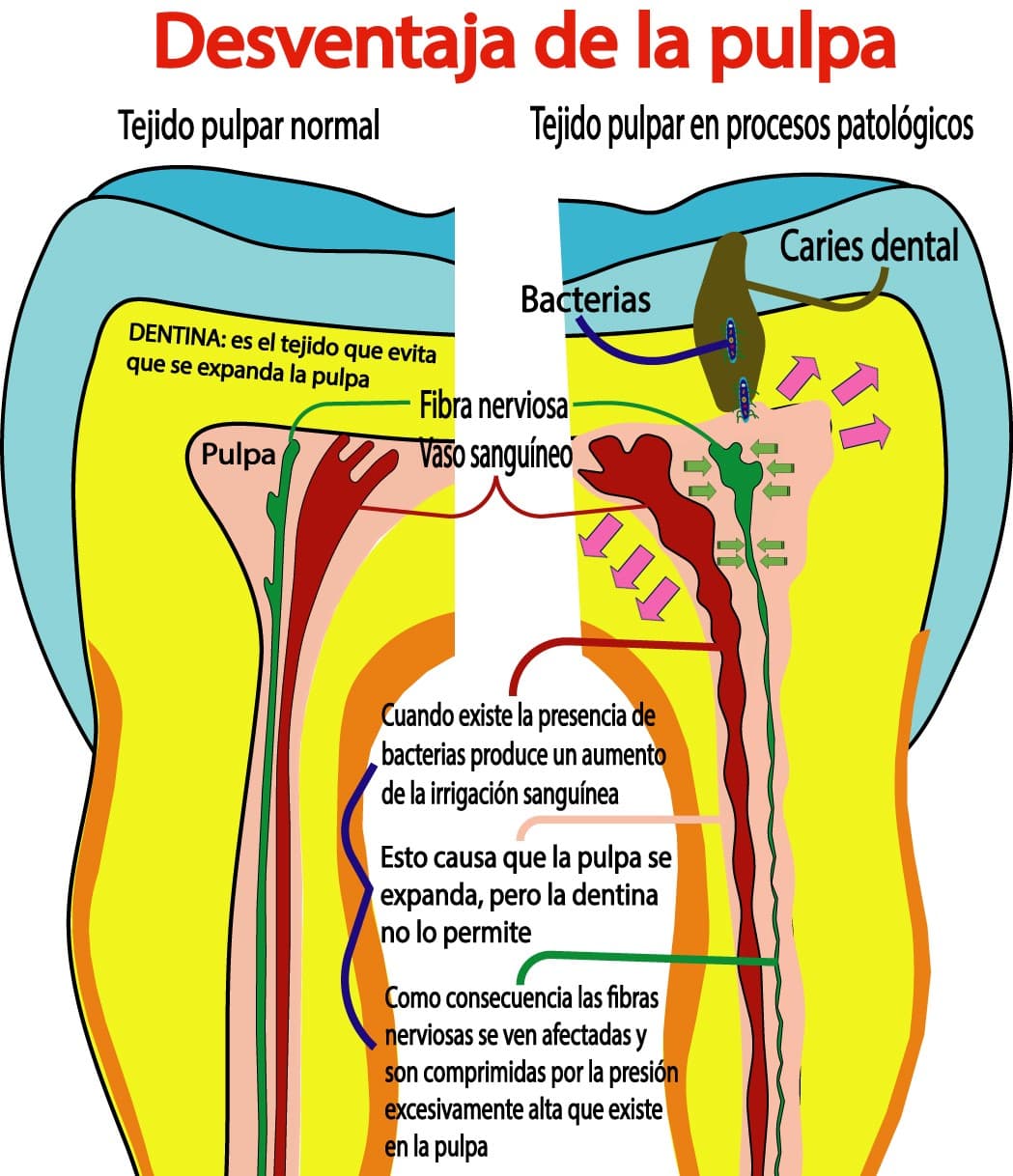 Primera desventaja anatómica de la pulpa dental