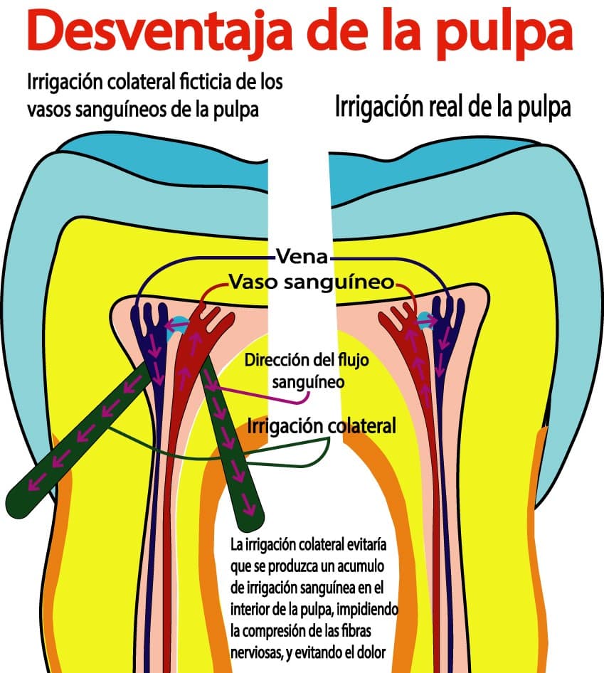 Segunda desventaja anatómica de la pulpa dental