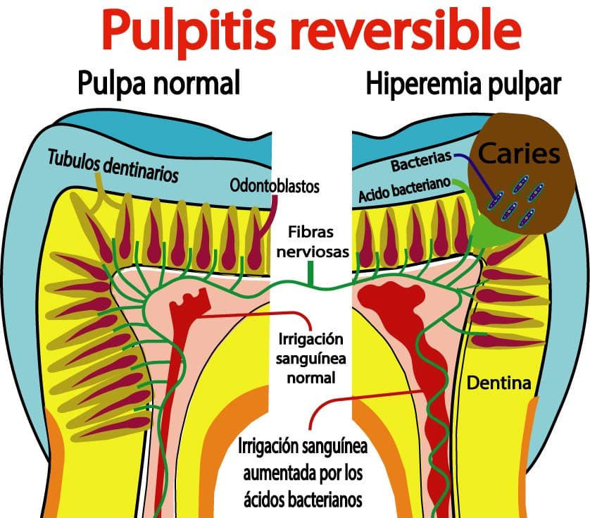 Pulpitis reversible
