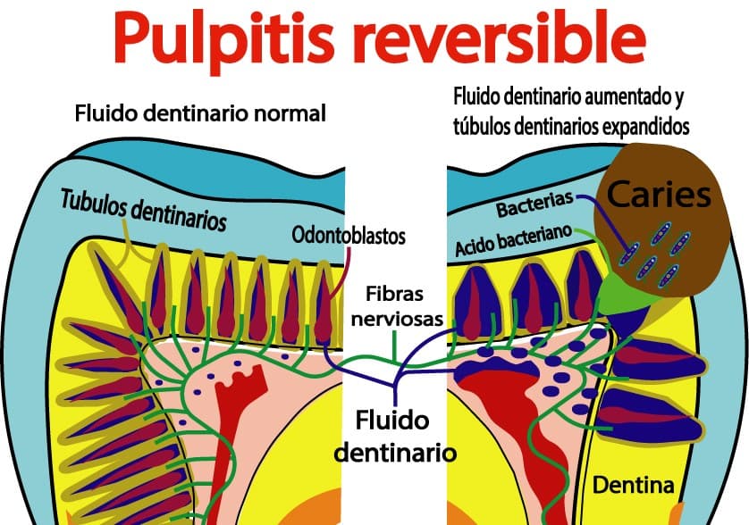 Representación de pulpitis reversible