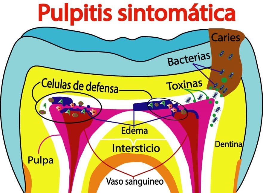 Pulpitis irreversible