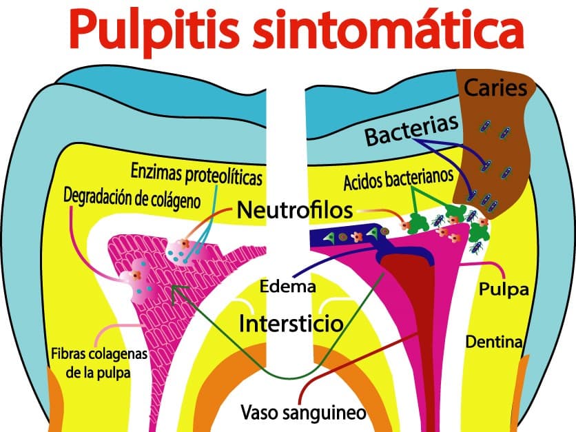 Proceso de pulpitis irreversible