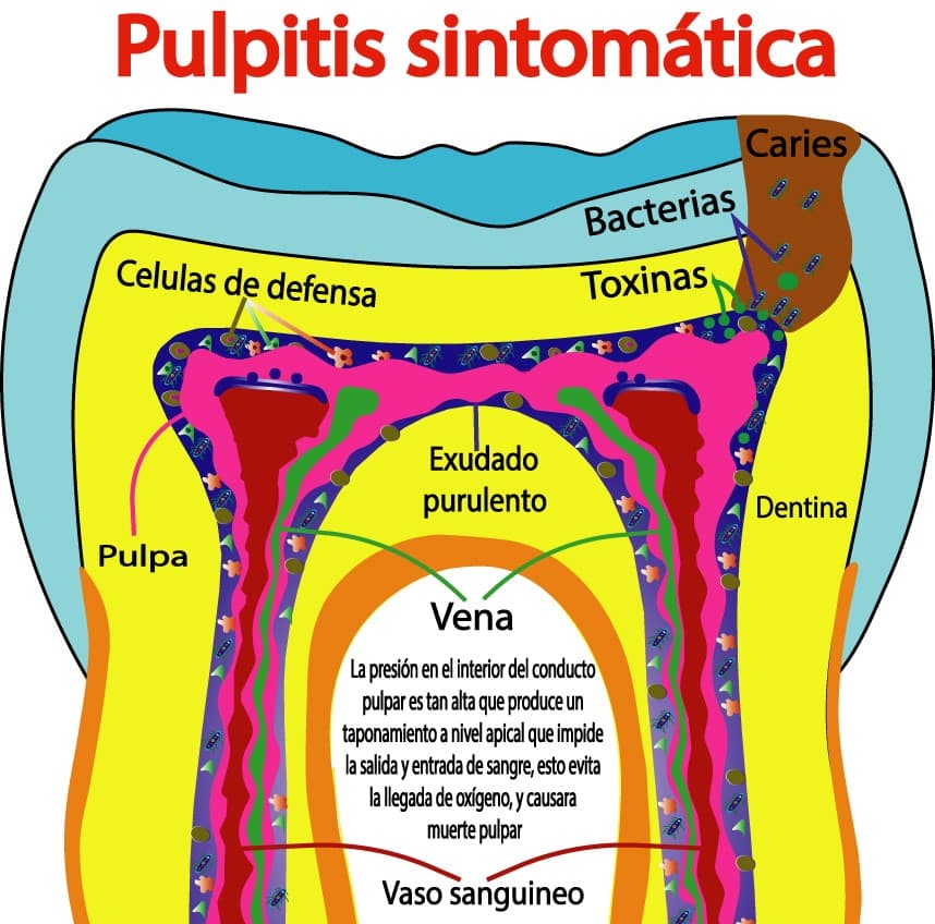 Pulpitis irreversible avanzada