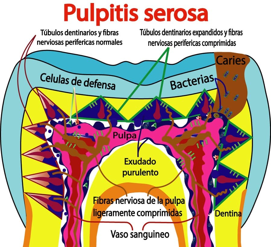 Pulpitis serosa