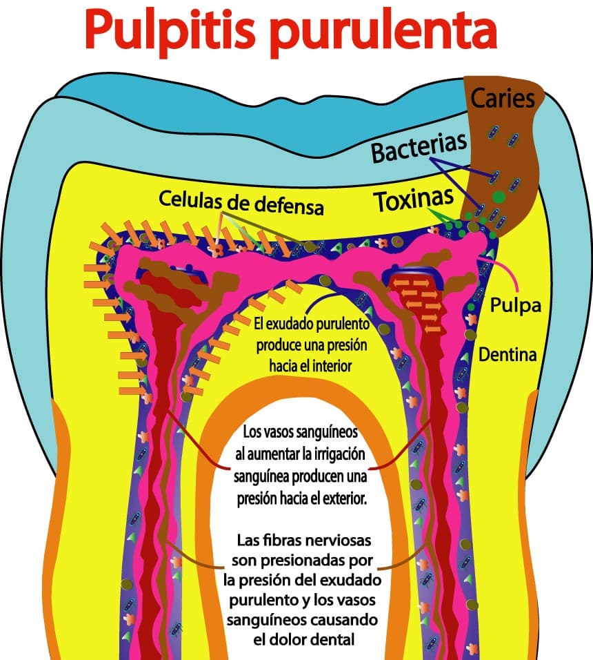 Pulpitis purulenta