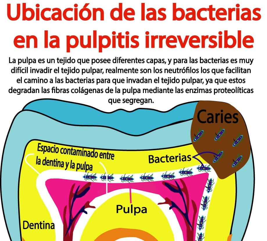 Contaminación del conducto radicular