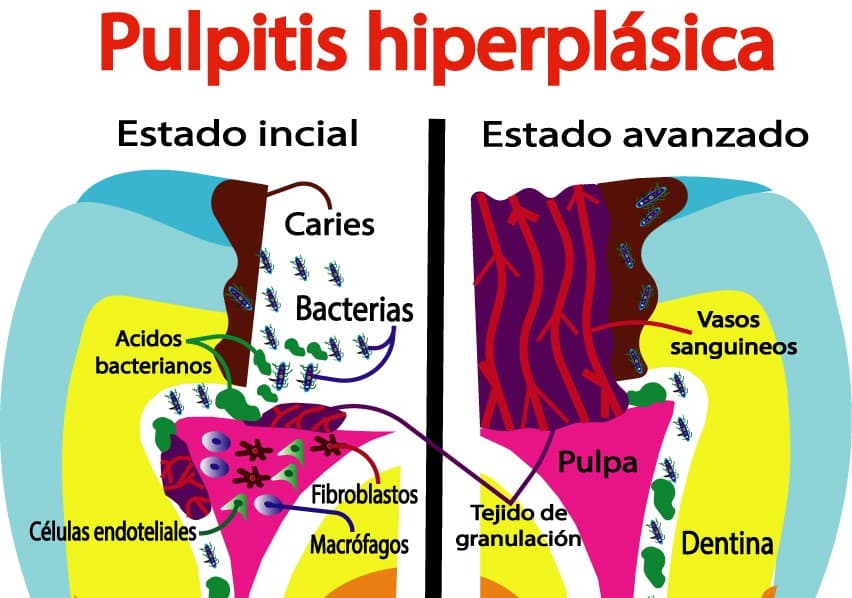 Pulpitis hiperplásica
