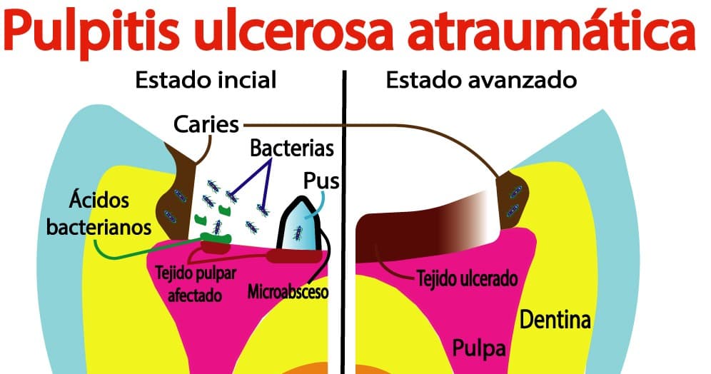 Pulpitis ulcerosa atraumática