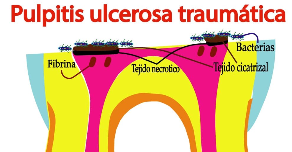 Pulpitis ulcerosa traumática