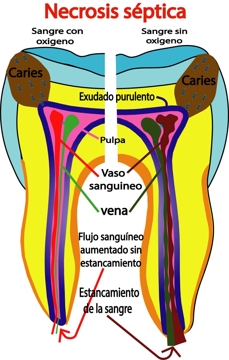 Necrosis séptica