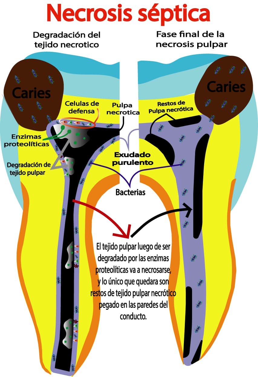 Necrosis pulpar en fase final