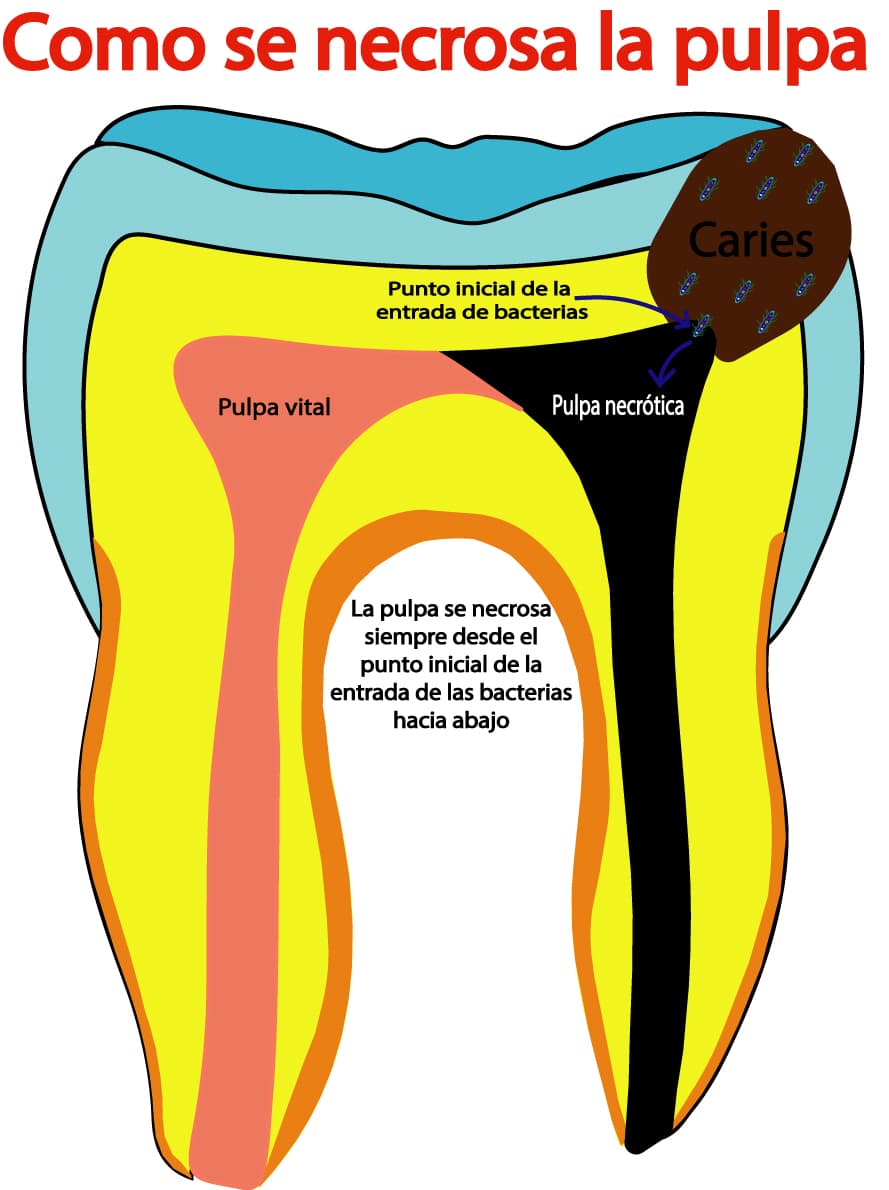 Secuencia de necrosis pulpar