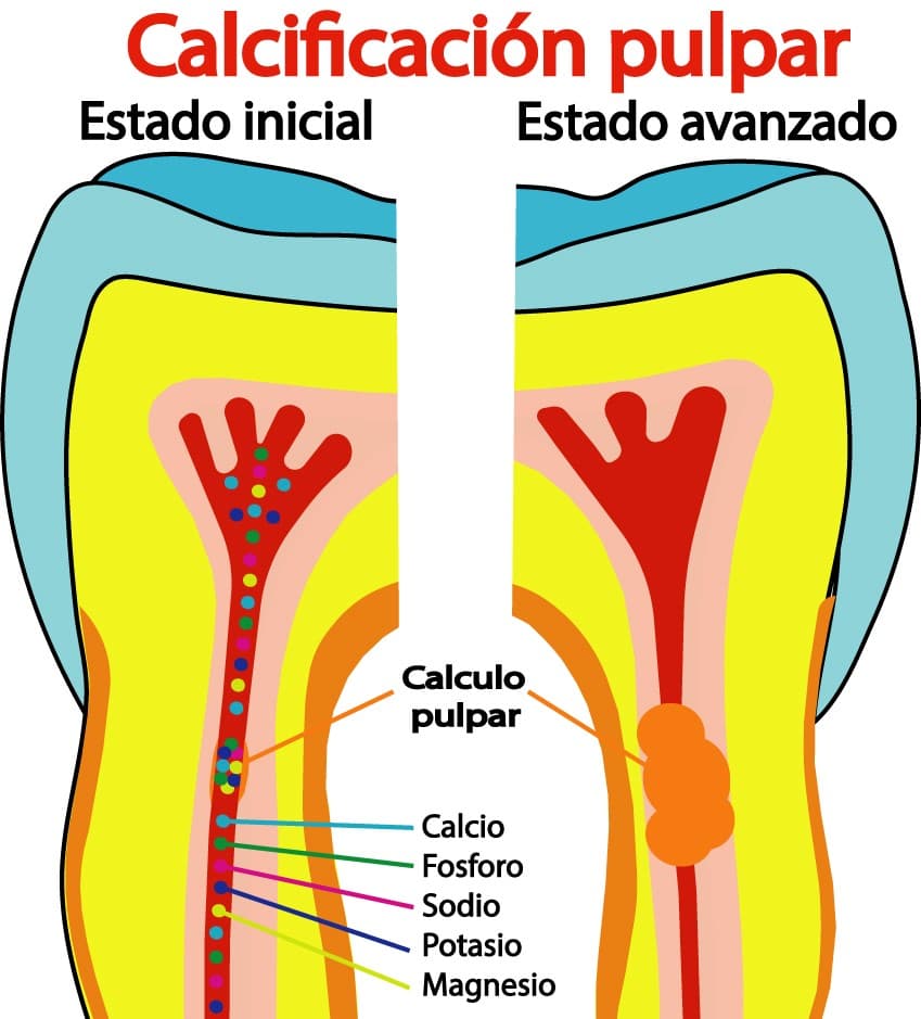 Calcificación pulpar
