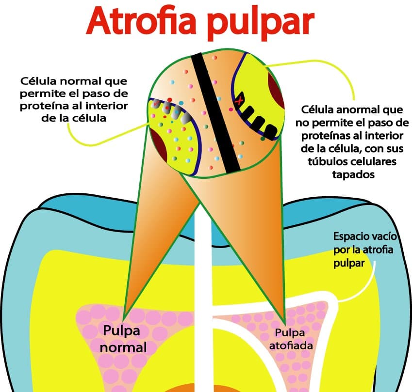 Atrofia pulpar