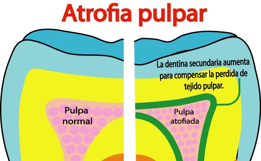 Atrofia pulpar en imagen complementaria