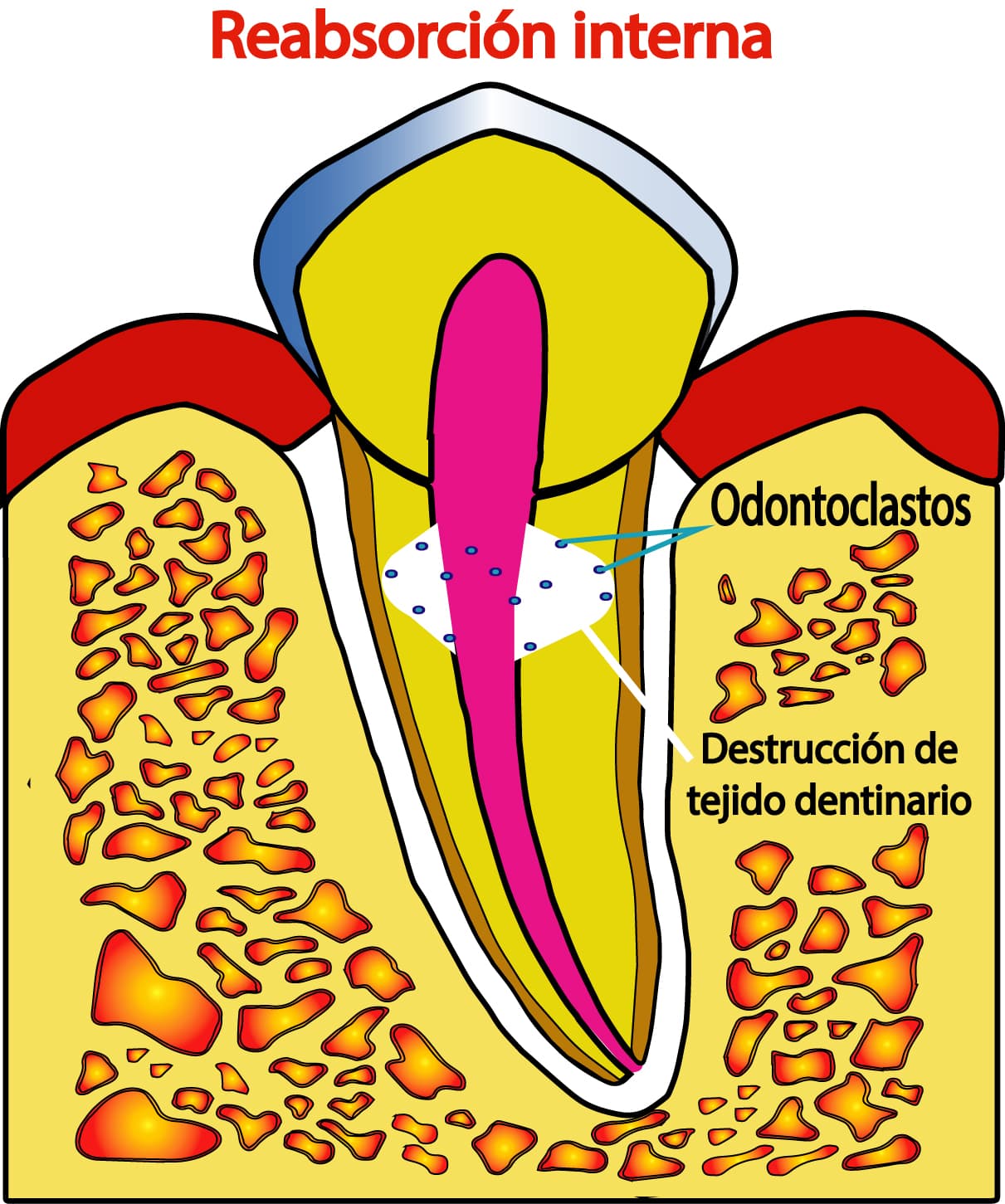 Reabsorción interna en imagen complementaria