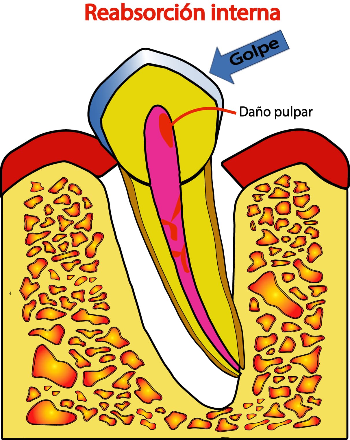 Reabsorción interna