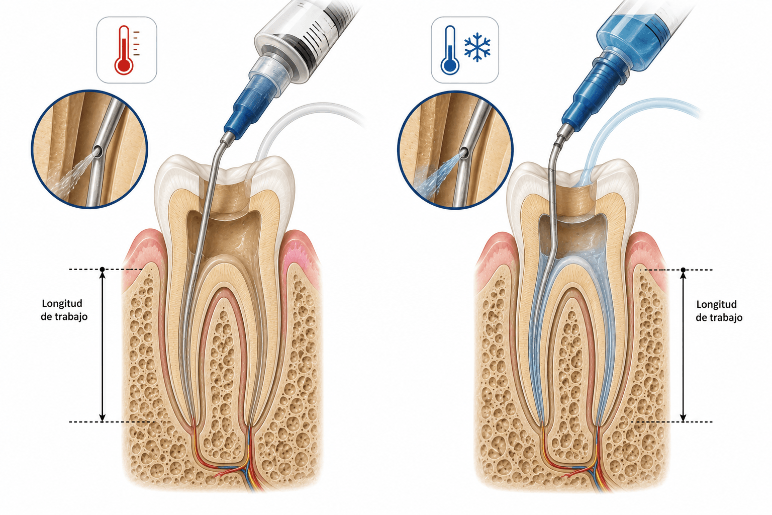 Figura 3 asociada a crioterapia intracanal en endodoncia